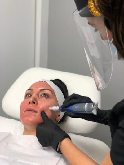SkinPen Treatments Before & After Gallery - Patient 214078 - Image 1