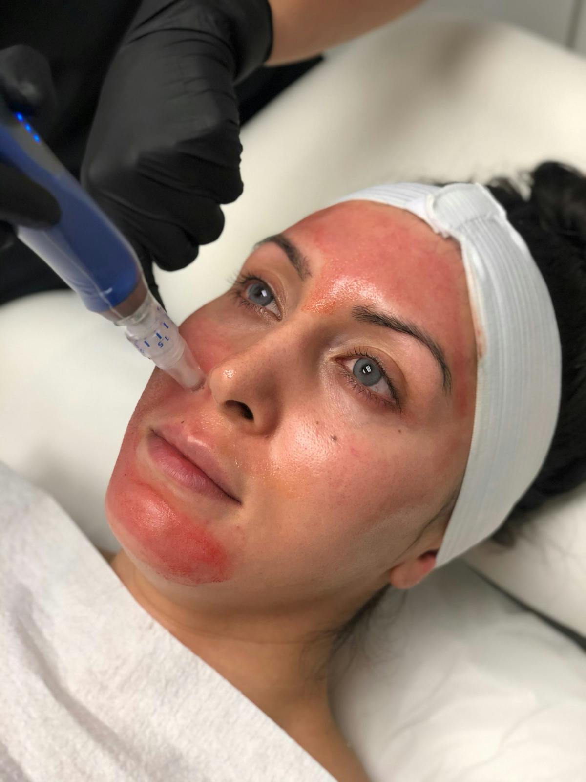 SkinPen Treatments Before & After Gallery - Patient 214078 - Image 2