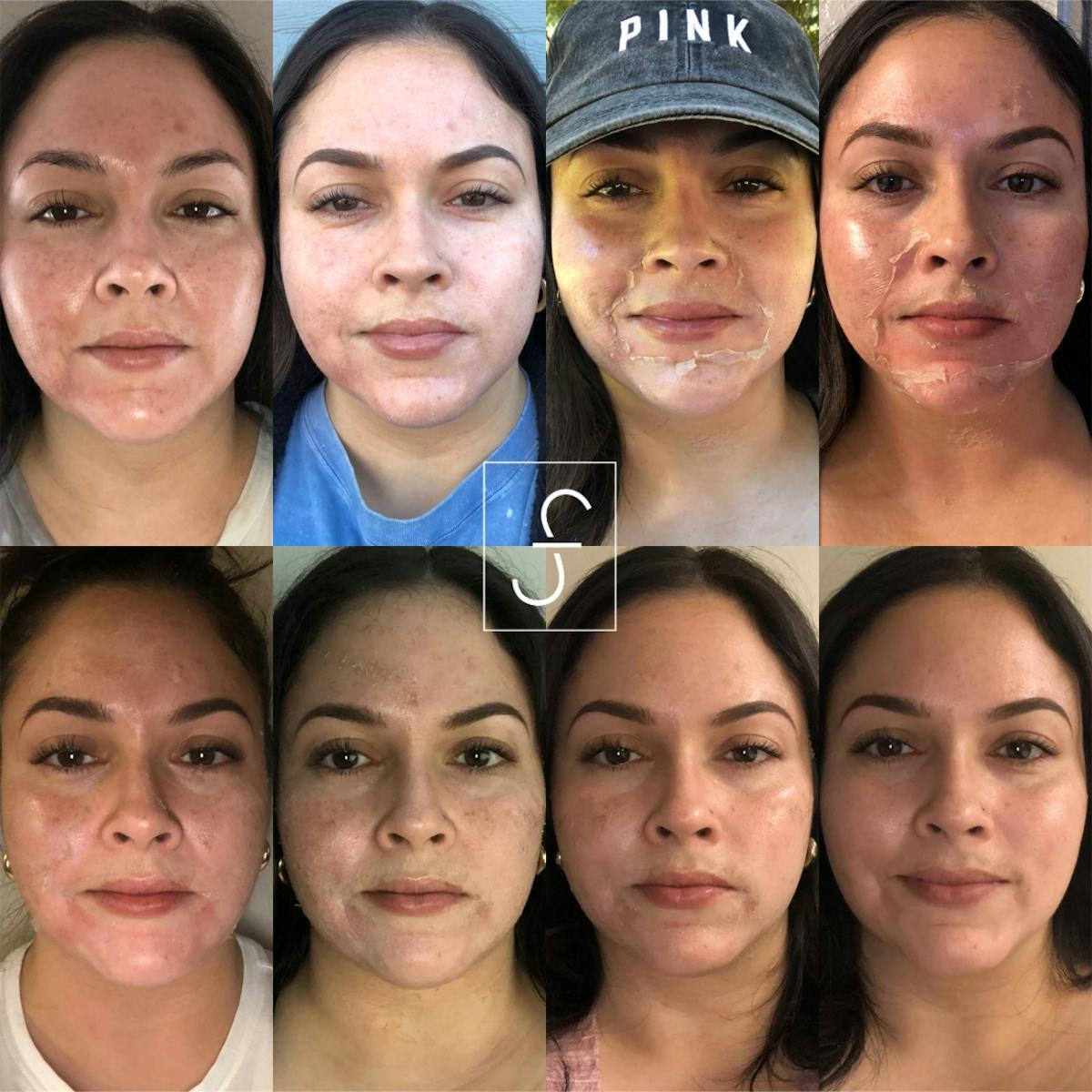 Vi Peel Before & After Gallery - Patient 158005 - Image 1