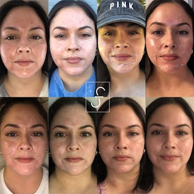 Vi Peel Before & After Gallery - Patient 158005 - Image 1