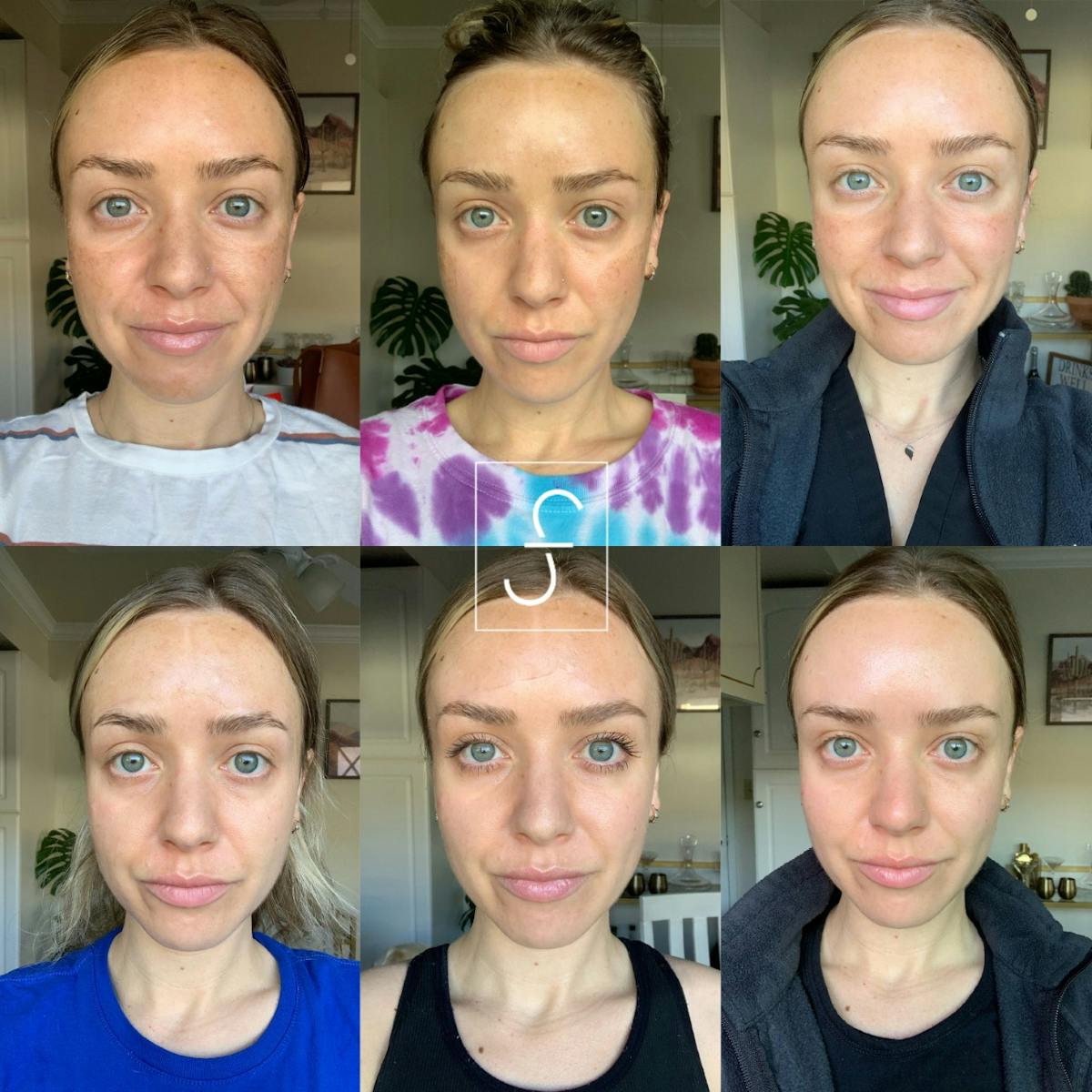 ZO 3-Step Peel Before & After Gallery - Patient 225406 - Image 1