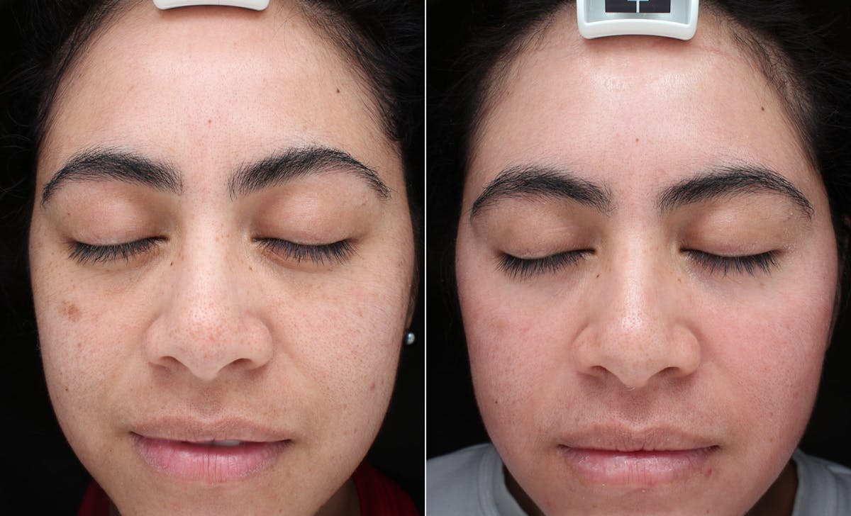 ZO Skincare Before & After Gallery - Patient 276087 - Image 1