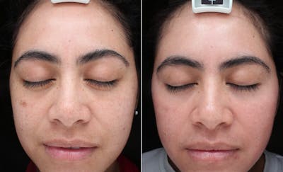 ZO Skincare Before & After Gallery - Patient 276087 - Image 1