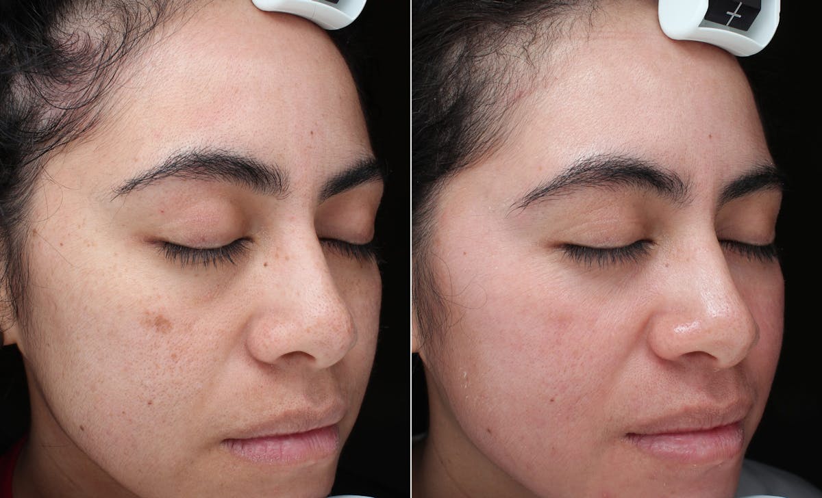 ZO Skincare Before & After Gallery - Patient 276087 - Image 2