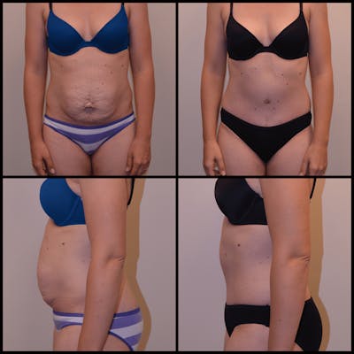 Abdominoplasty (Tummy Tuck) Before & After Gallery - Patient 164031 - Image 1