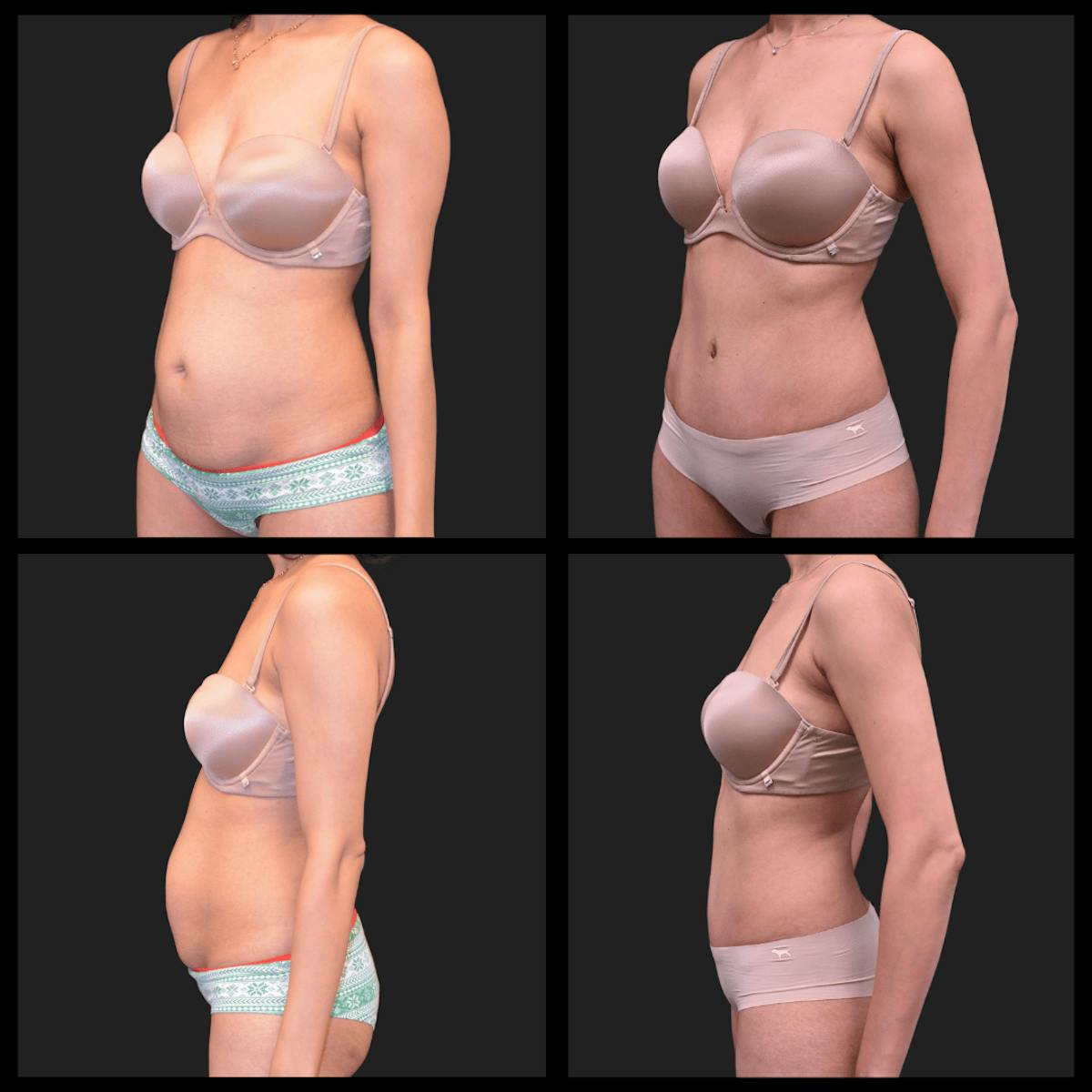 Abdominoplasty (Tummy Tuck) Before & After Gallery - Patient 225131 - Image 1
