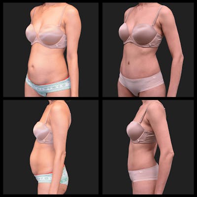 Abdominoplasty (Tummy Tuck) Before & After Gallery - Patient 225131 - Image 1
