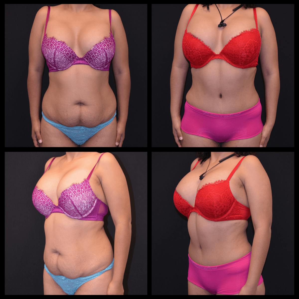 Abdominoplasty (Tummy Tuck) Before & After Gallery - Patient 337631 - Image 1