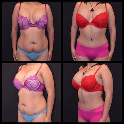 Abdominoplasty (Tummy Tuck) Before & After Gallery - Patient 337631 - Image 1