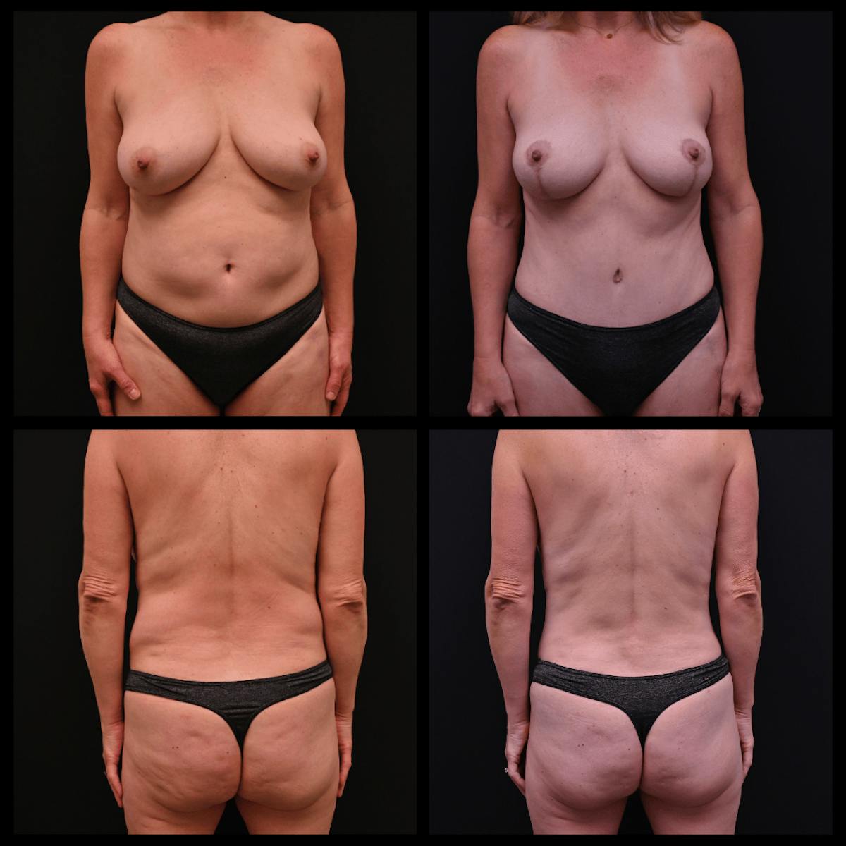 Mommy Makeover Before & After Gallery - Patient 429208 - Image 1