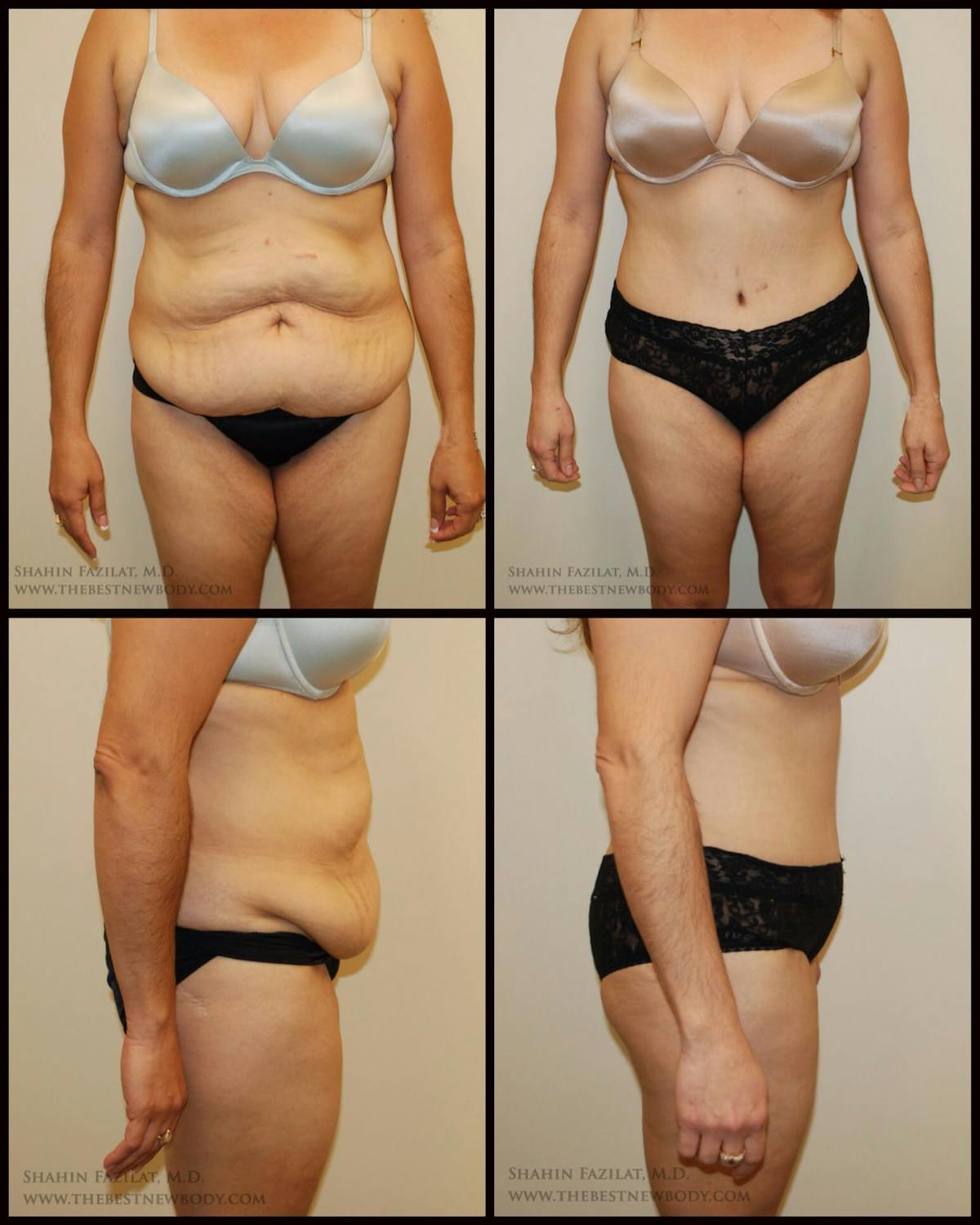Abdominoplasty (Tummy Tuck) Before & After Gallery - Patient 293532 - Image 1