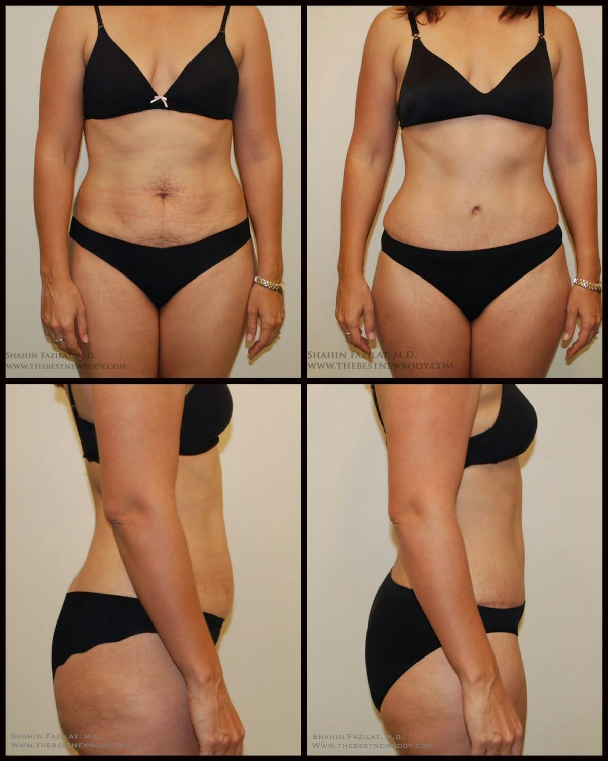 Abdominoplasty (Tummy Tuck) Before & After Gallery - Patient 326565 - Image 1