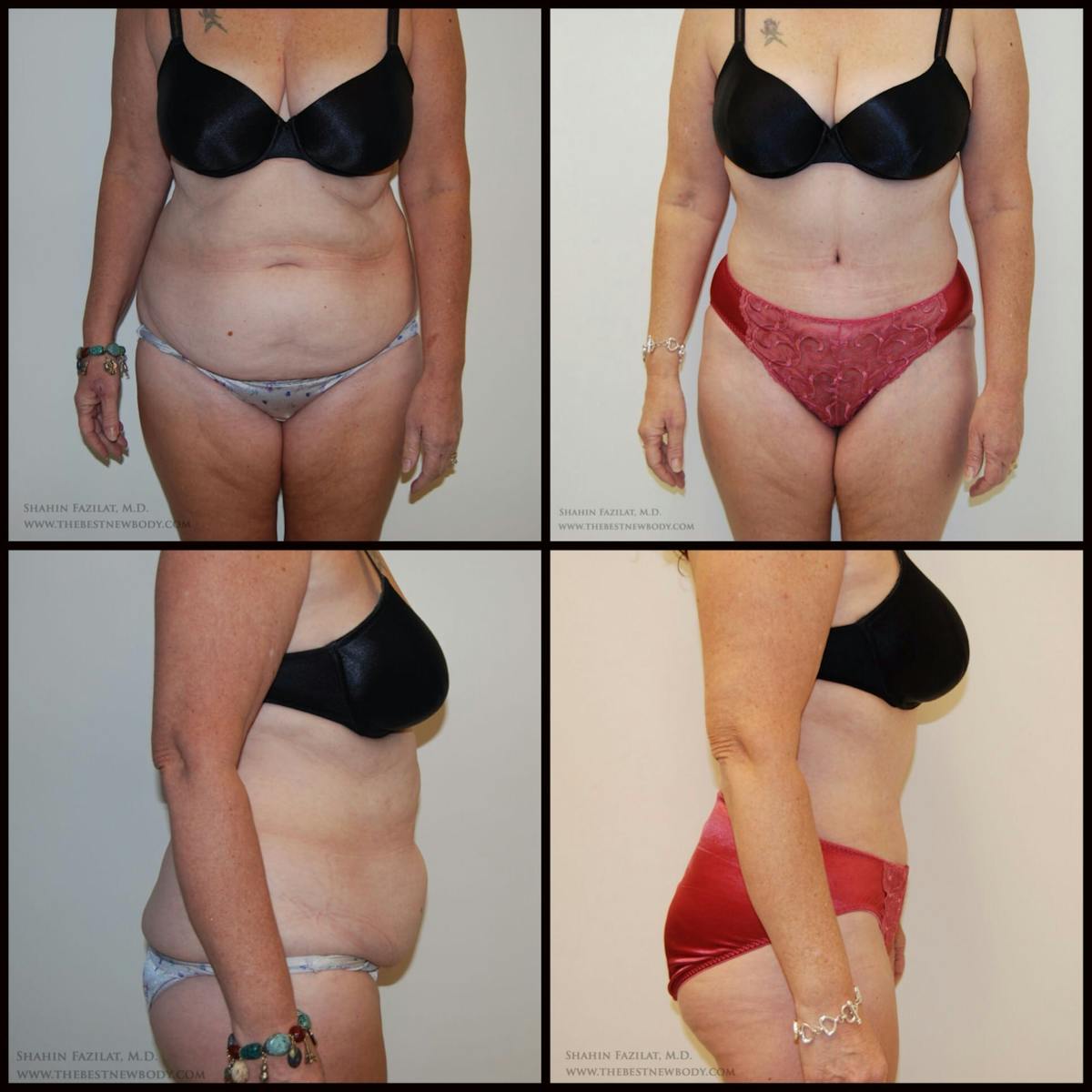 Abdominoplasty (Tummy Tuck) Before & After Gallery - Patient 285012 - Image 1