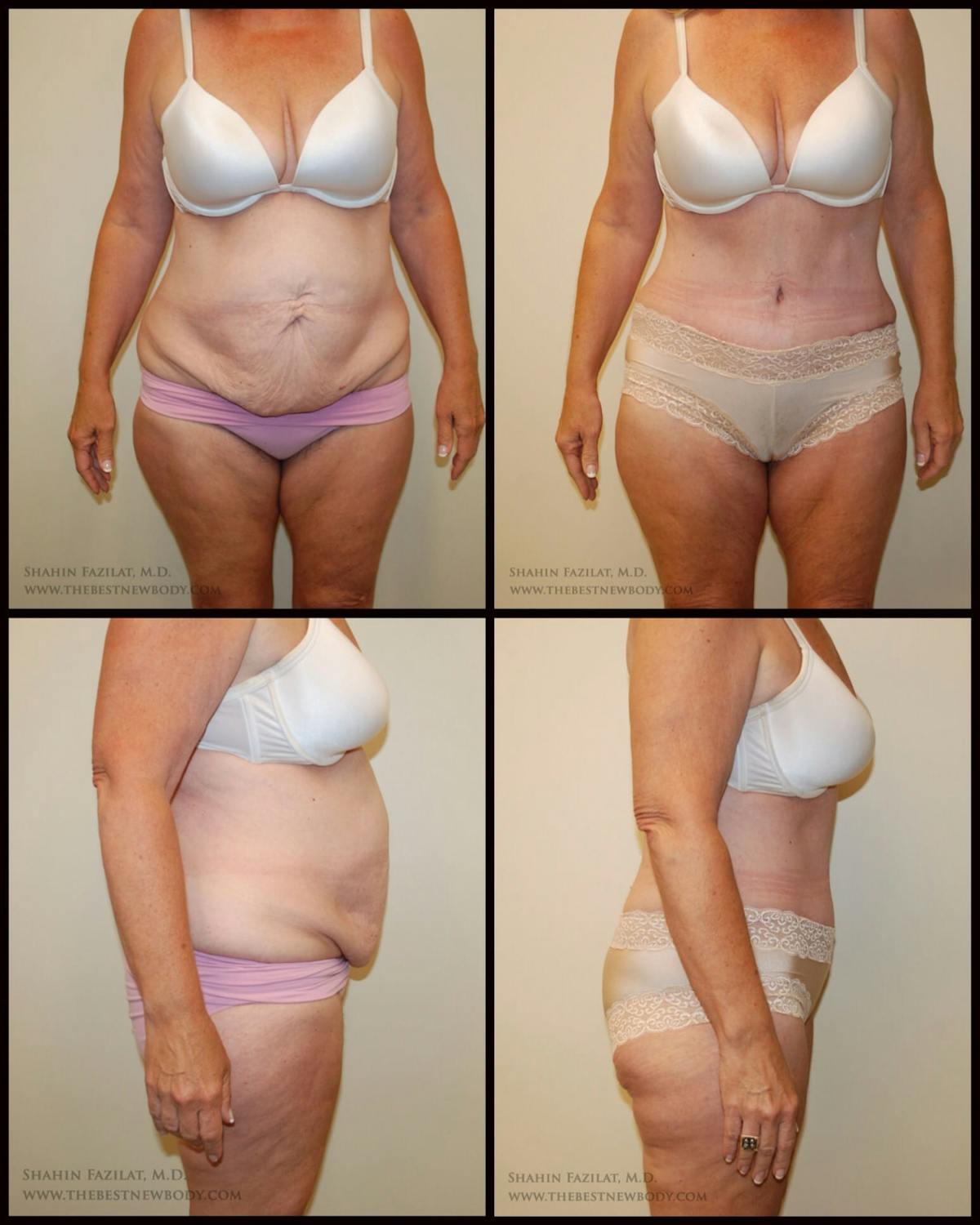 Abdominoplasty (Tummy Tuck) Before & After Gallery - Patient 188488 - Image 1