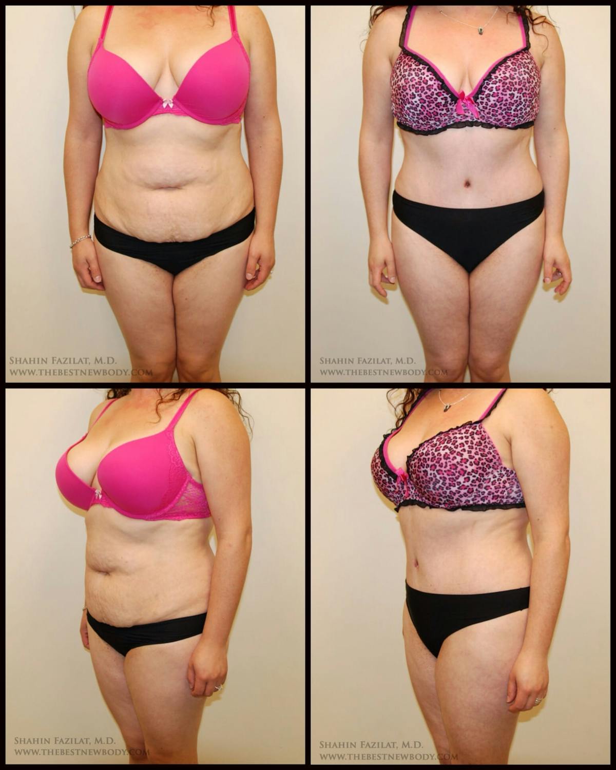Abdominoplasty (Tummy Tuck) Before & After Gallery - Patient 288047 - Image 1