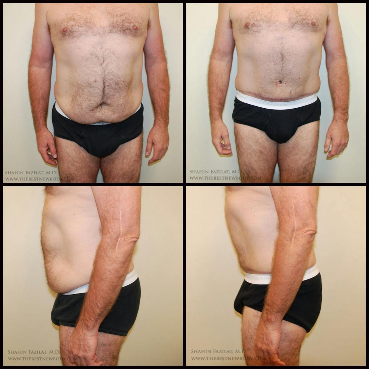 Abdominoplasty (Tummy Tuck) Before & After Gallery - Patient 117410 - Image 1