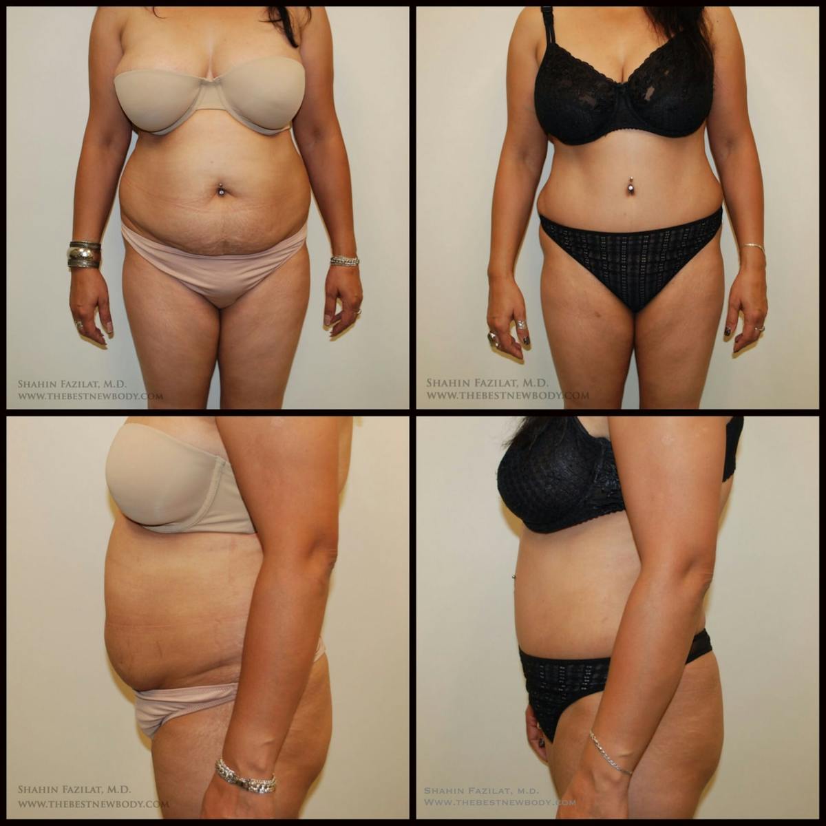 Abdominoplasty (Tummy Tuck) Before & After Gallery - Patient 341694 - Image 1