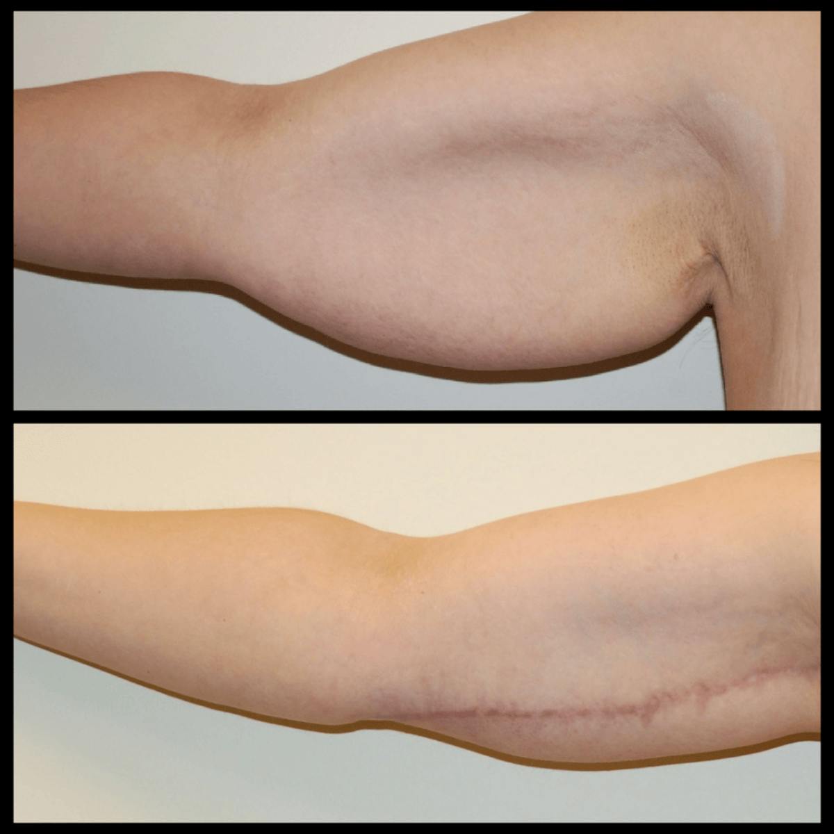 Arm Lift Before & After Gallery - Patient 416878 - Image 1