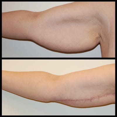 Arm Lift Before & After Gallery - Patient 416878 - Image 1