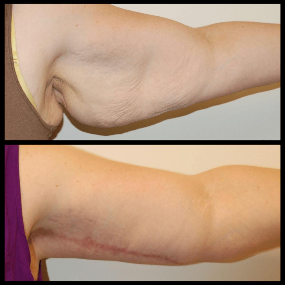 Arm Lift Before & After Gallery - Patient 416878 - Image 2