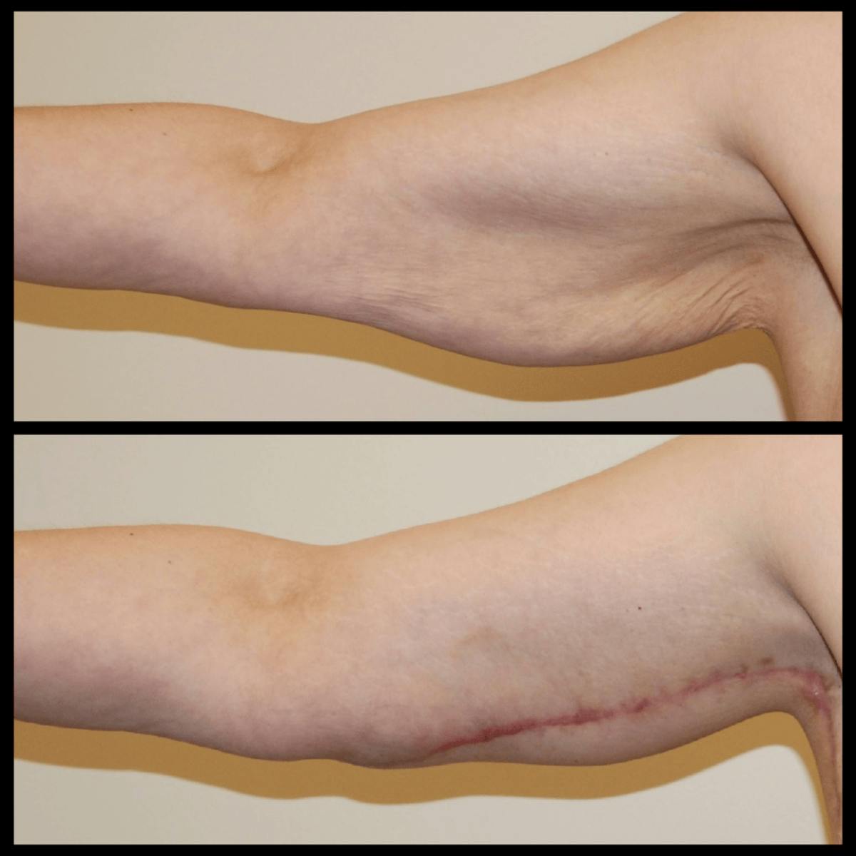 Arm Lift Before & After Gallery - Patient 135042 - Image 1