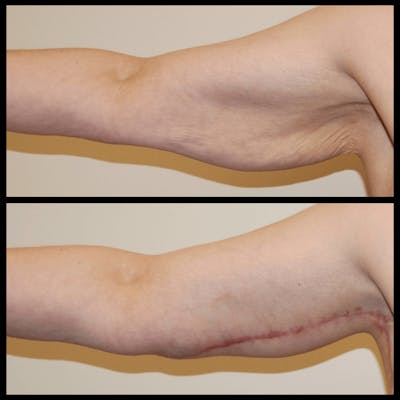 Arm Lift Before & After Gallery - Patient 135042 - Image 1