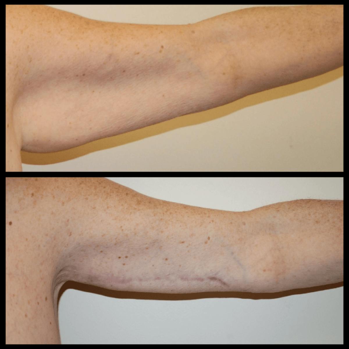 Arm Lift Before & After Gallery - Patient 135042 - Image 2