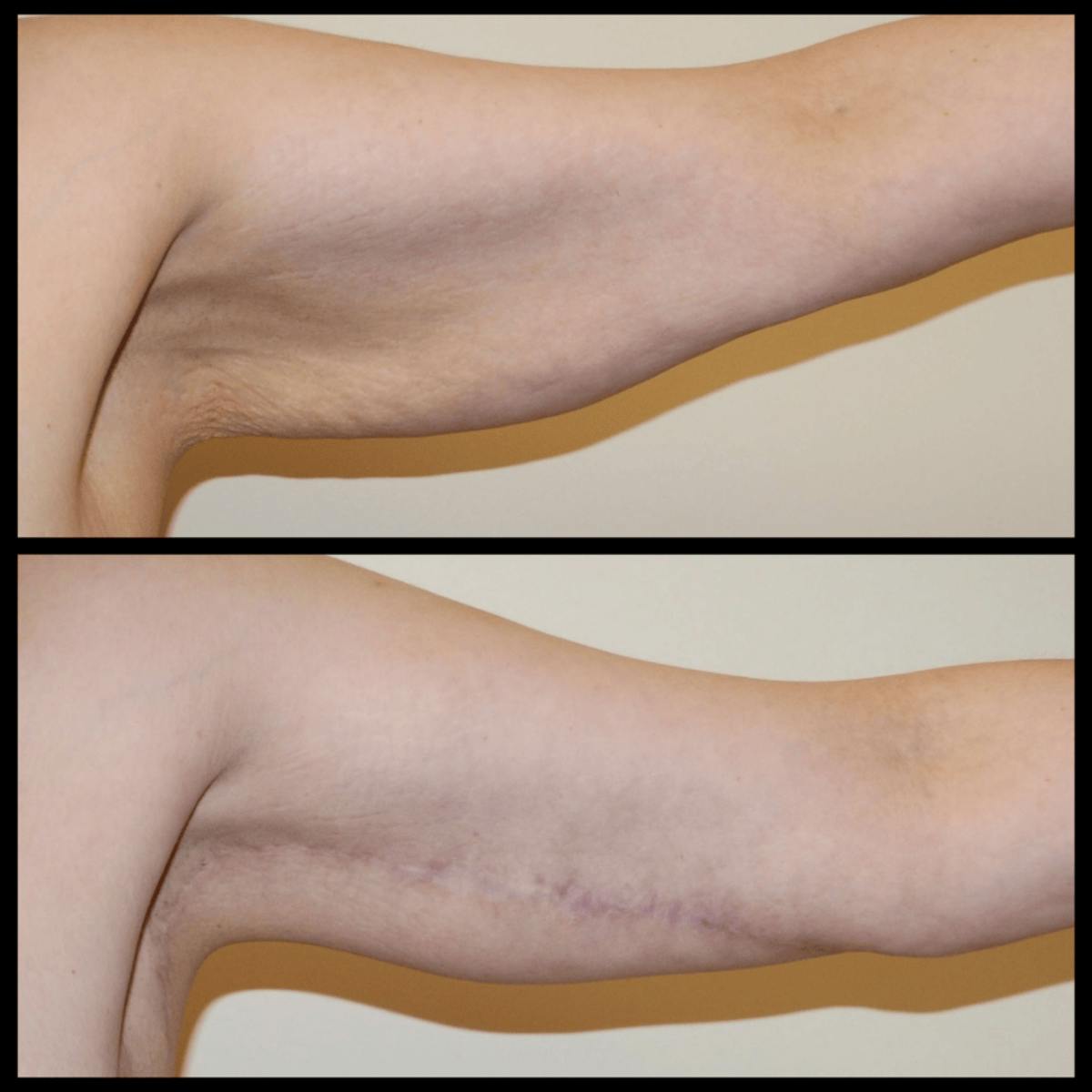 Arm Lift Before & After Gallery - Patient 379494 - Image 2