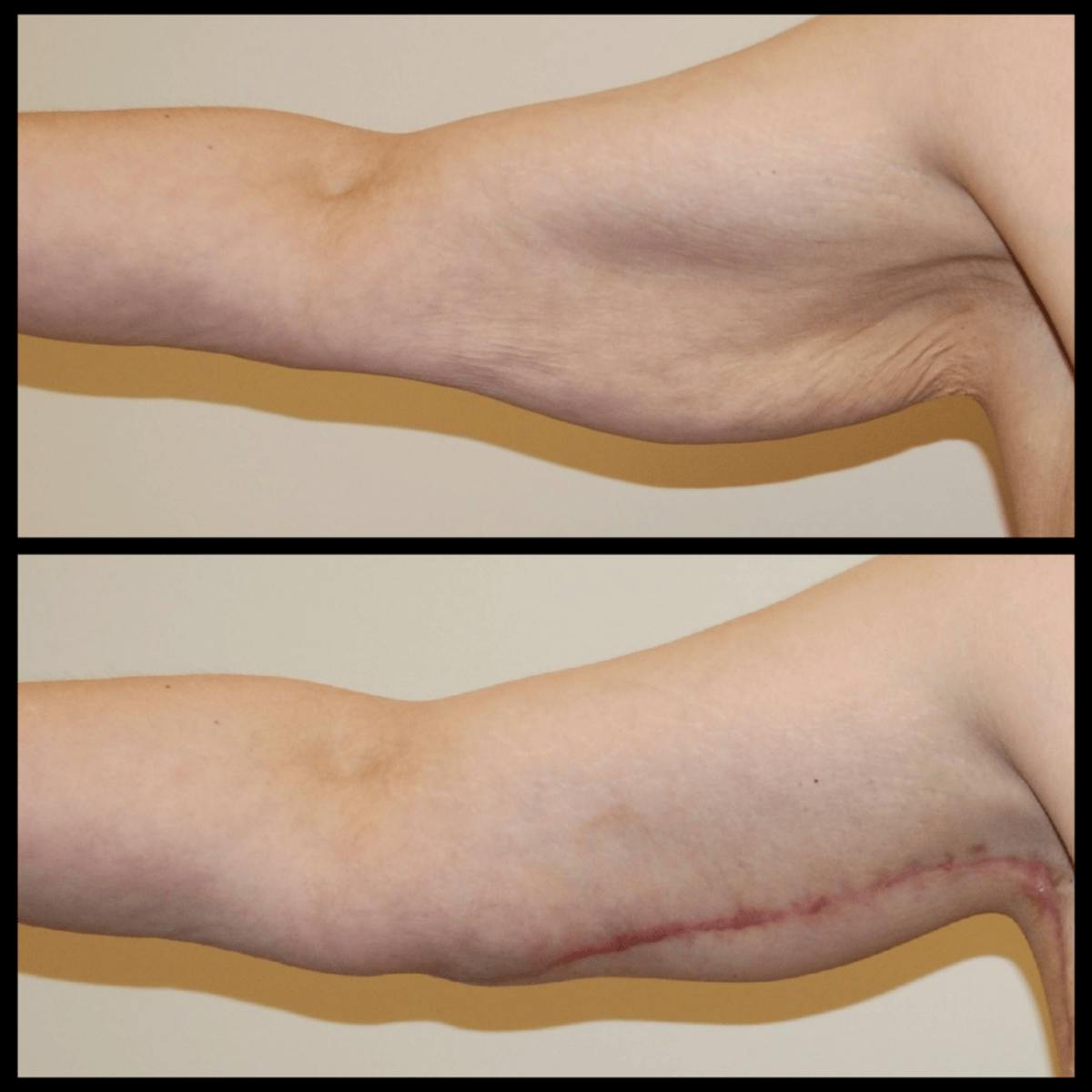 Arm Lift Before & After Gallery - Patient 379494 - Image 1