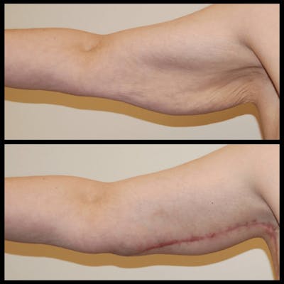 Arm Lift Before & After Gallery - Patient 379494 - Image 1