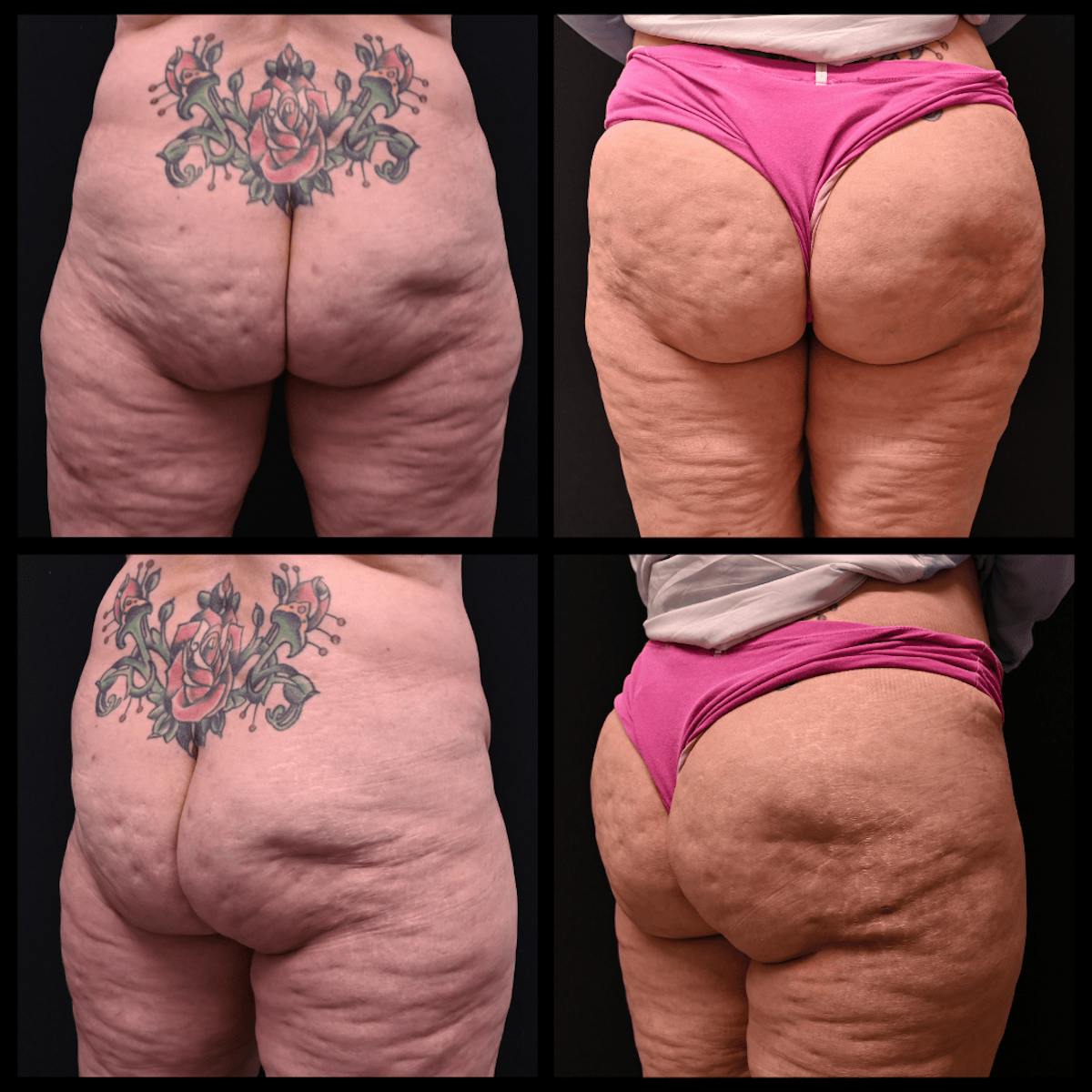 Aveli Cellulite Reduction Before & After Gallery - Patient 904115 - Image 1
