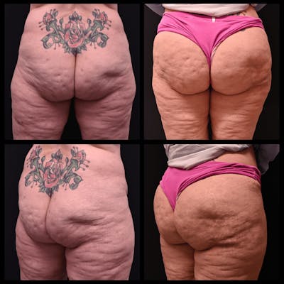 Brazilian Butt Lift Before & After Gallery - Patient 286884 - Image 1