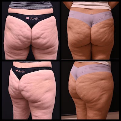 Aveli Cellulite Reduction Before & After Gallery - Patient 148185 - Image 1