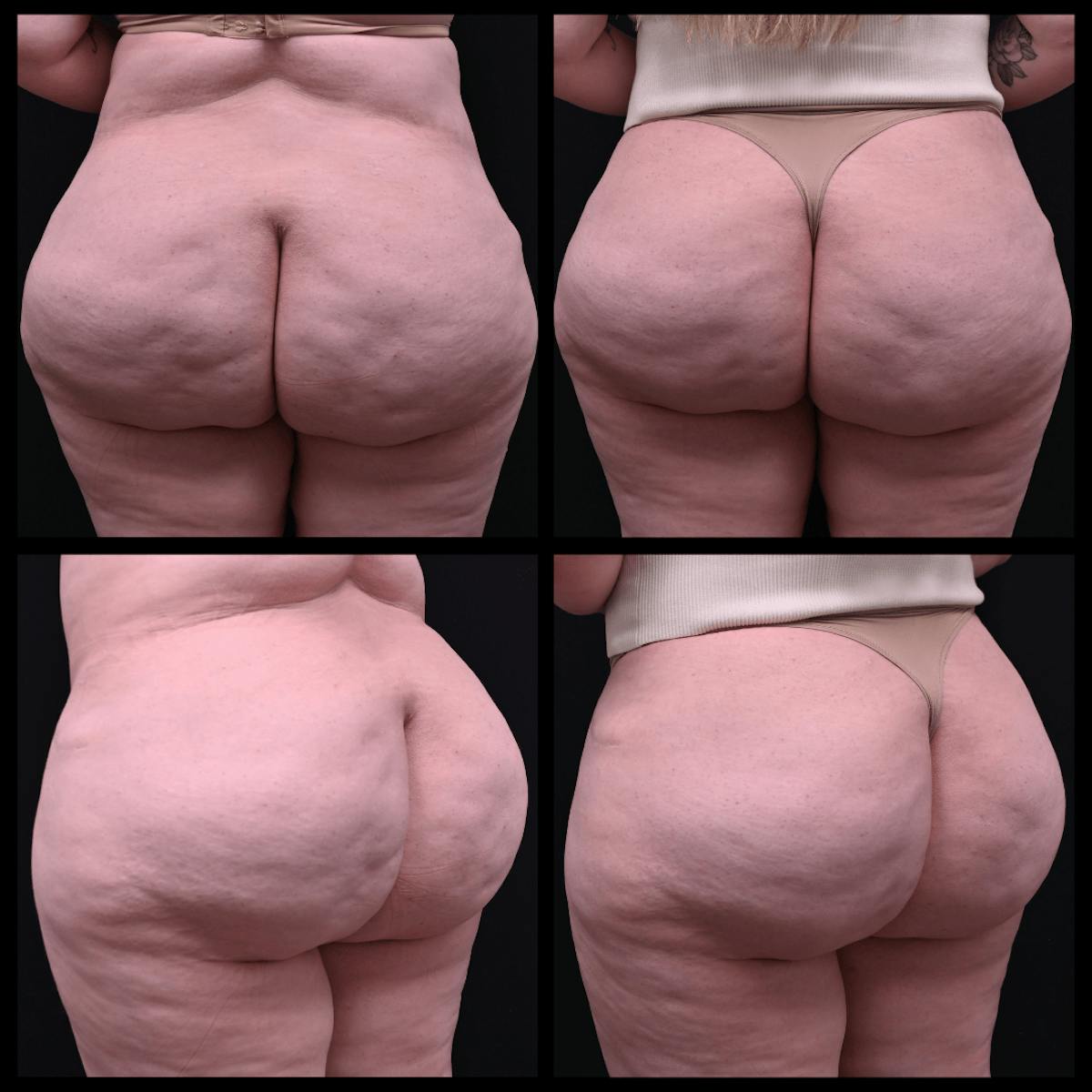 Aveli Cellulite Reduction Before & After Gallery - Patient 393330 - Image 1