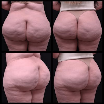 Aveli Cellulite Reduction Before & After Gallery - Patient 393330 - Image 1