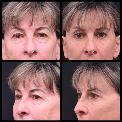 Blepharoplasty (Eyelid Surgery) Before & After Gallery - Patient 313440 - Image 1