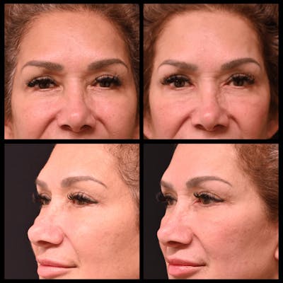 Blepharoplasty (Eyelid Surgery) Before & After Gallery - Patient 328514 - Image 1