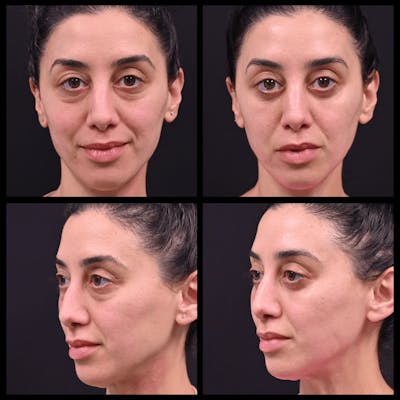 Blepharoplasty (Eyelid Surgery) Before & After Gallery - Patient 119273 - Image 1