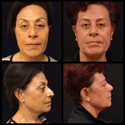 Blepharoplasty (Eyelid Surgery) Before & After Gallery - Patient 636565 - Image 1