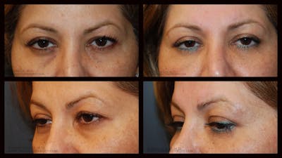 Blepharoplasty (Eyelid Surgery) Before & After Gallery - Patient 541454 - Image 1