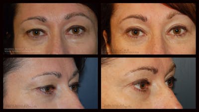 Blepharoplasty (Eyelid Surgery) Before & After Gallery - Patient 103224 - Image 1