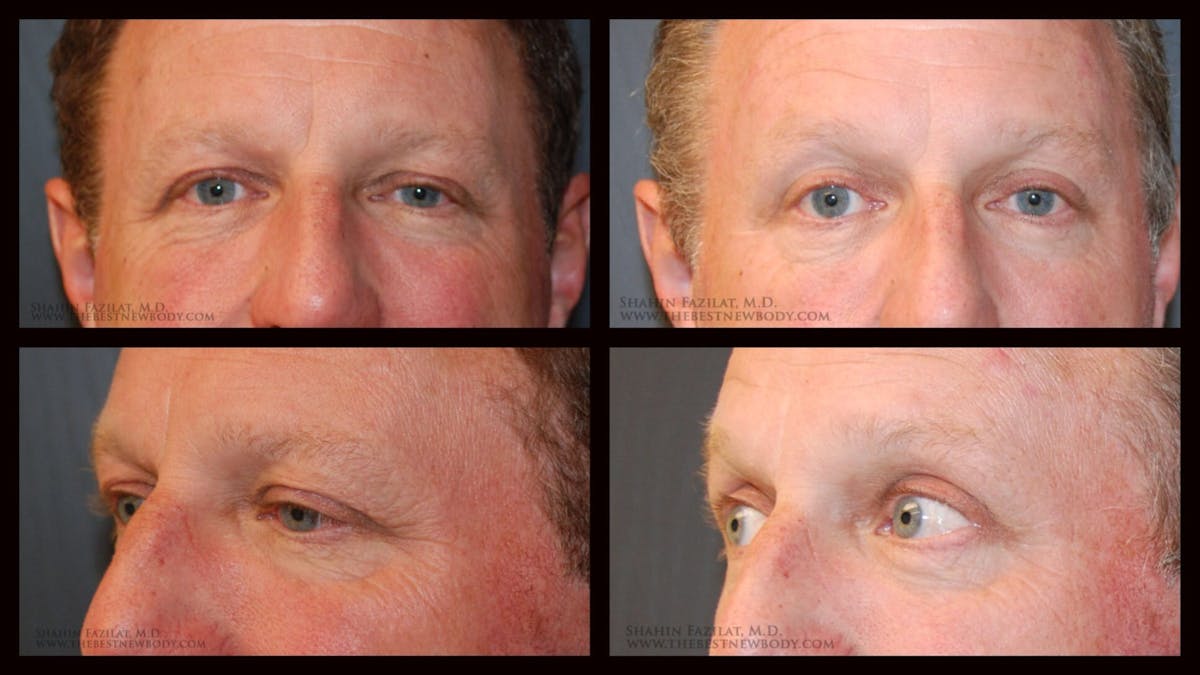 Blepharoplasty (Eyelid Surgery) Before & After Gallery - Patient 148371 - Image 1