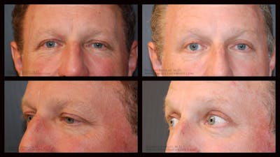 Blepharoplasty (Eyelid Surgery) Before & After Gallery - Patient 148371 - Image 1
