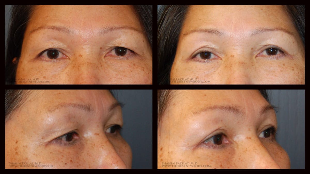 Blepharoplasty (Eyelid Surgery) Before & After Gallery - Patient 311268 - Image 1
