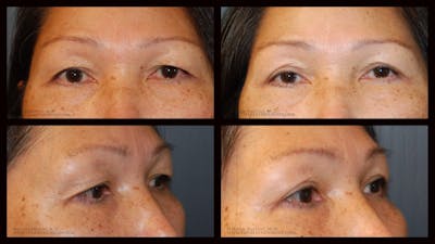 Blepharoplasty (Eyelid Surgery) Before & After Gallery - Patient 311268 - Image 1