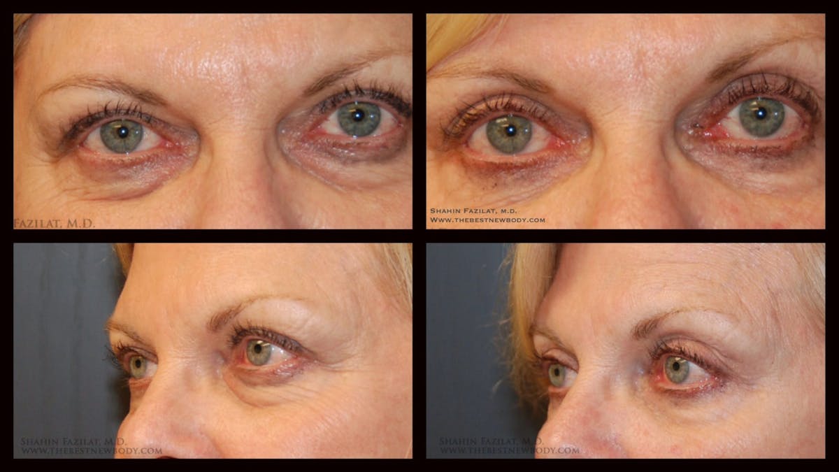 Blepharoplasty (Eyelid Surgery) Before & After Gallery - Patient 179153 - Image 1