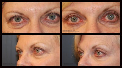 Blepharoplasty (Eyelid Surgery) Before & After Gallery - Patient 179153 - Image 1