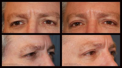 Blepharoplasty (Eyelid Surgery) Before & After Gallery - Patient 356408 - Image 1