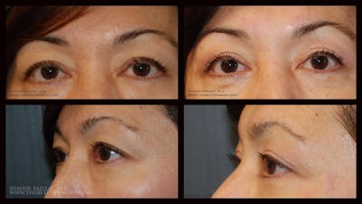 Blepharoplasty (Eyelid Surgery) Before & After Gallery - Patient 280132 - Image 1