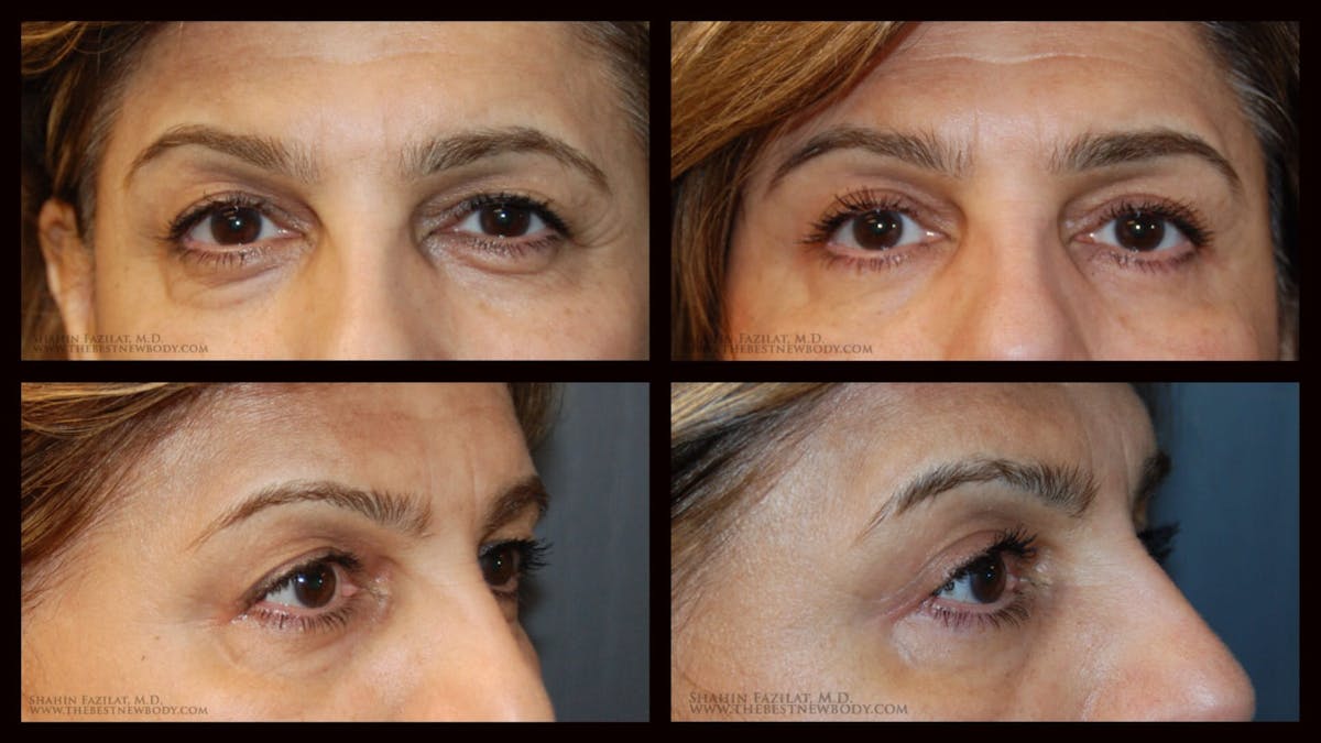 Blepharoplasty (Eyelid Surgery) Before & After Gallery - Patient 390991 - Image 1